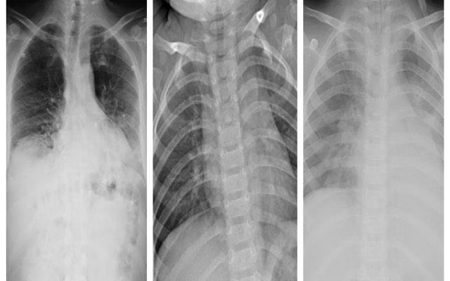 An X-ray of lungs with pneumonia